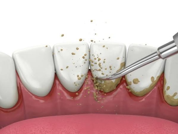 Quy trình chăm sóc đúng sau cạo vôi