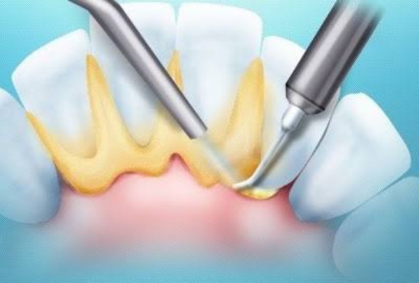 Cạo vôi răng có làm trắng răng không? Quy trình như thế nào?