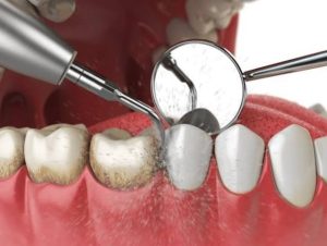 Nên ăn gì trong 24 giờ sau cạo vôi?