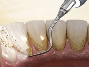 Vì sao cạo vôi răng 6 tháng một lần là bắt buộc?
