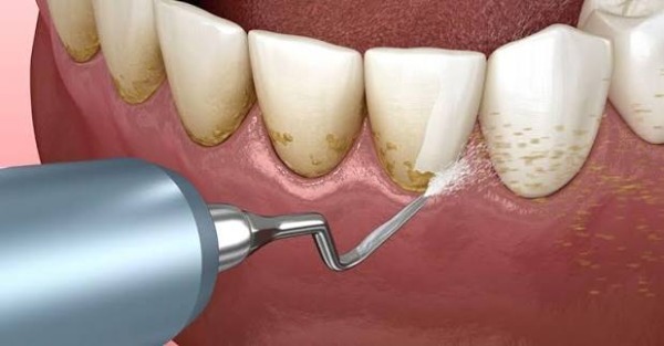 Làm cách nào chăm sóc đúng cách sau cạo vôi để nướu phục hồi nhanh?