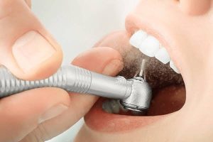 Vì sao dán veneer sứ cần mài lớp men răng?