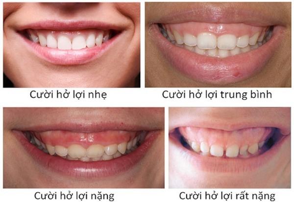 Cắt nướu bằng điện có những ưu và nhược điểm nào?