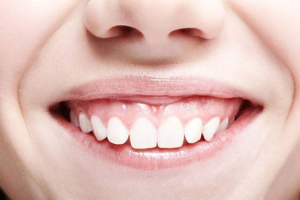 Cười hở lợi là bệnh di truyền không?
