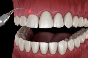 Cắt nướu điện vs laser phương pháp nào phù hợp với bạn?