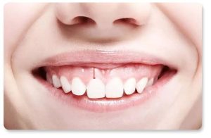 Tại sao cắt nướu là can thiệp quan trọng cần lựa chọn công nghệ phù hợp?