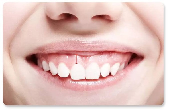 Tại sao cắt nướu là can thiệp quan trọng cần lựa chọn công nghệ phù hợp?