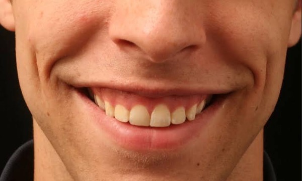 4 phương pháp điều trị cười hở lợi hiệu quả