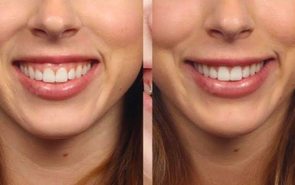 Cười hở lợi là gì và tại sao xảy ra?