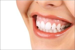 Nướu lộ khi cười là hiện tượng gì?