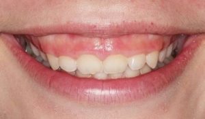 Cười hở lợi có tự hết được không? Giải đáp chi tiết