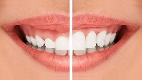 Cười hở lợi là gì và tại sao cần che giấu?