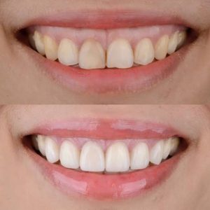 Kỹ thuật make-up kết hợp để che giấu hiệu quả