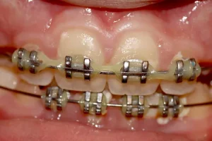 lips gums perfect smile aesthetics