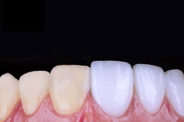 Vì sao cần phục hình thẩm mỹ với độ xâm lấn tối thiểu