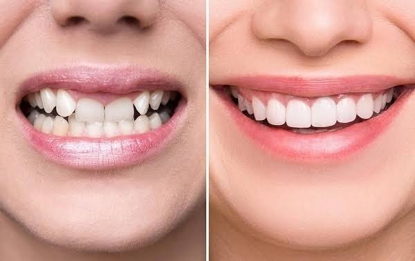 Tại sao bàn chải lựa chọn lại quan trọng cho veneer?
