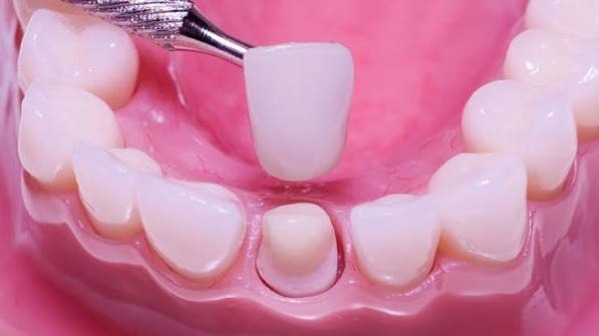 Những rủi ro khi tháo dán veneer là gì?