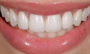 Tháo dán sứ veneer có làm hại răng thật? Sự thật từ nha sĩ