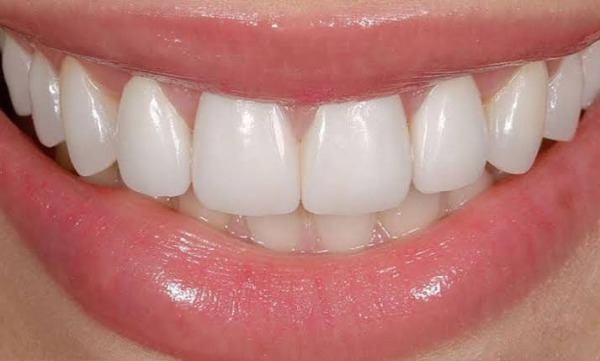 Làm thế nào để phòng ngừa hôi miệng sau khi dán veneer?