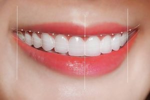 Phải chăm sóc veneer hàng ngày thế nào?