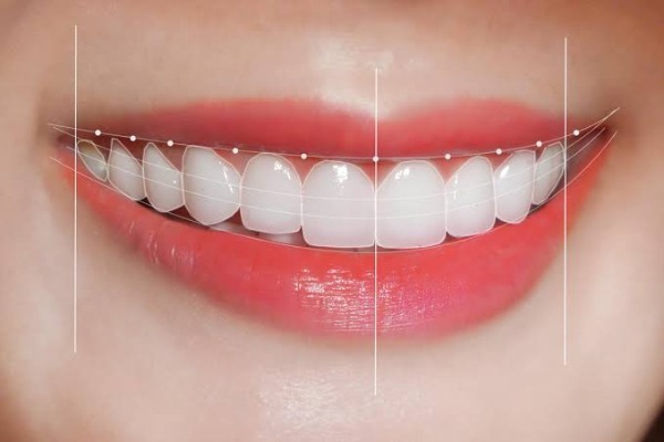 Hướng dẫn chăm sóc và tuổi thọ veneer Ultrathin