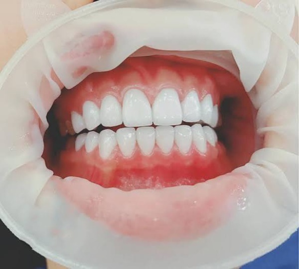 Dán sứ veneer bản thân có gây hôi miệng không?