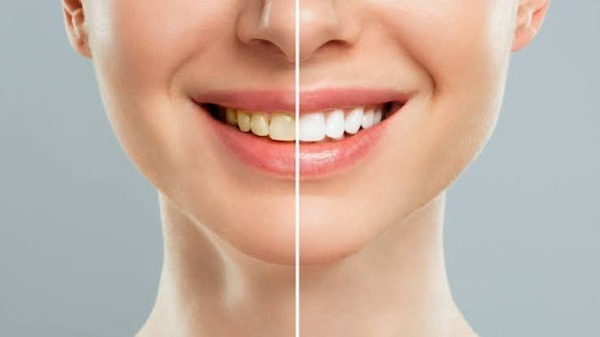 Baking soda hoạt động như thế nào để làm trắng răng?