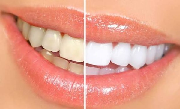 Làm sao để giảm ê buốt và chăm sóc sau tẩy trắng?