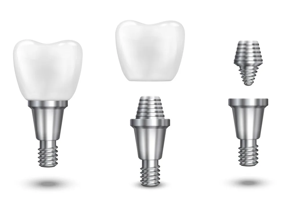 So sánh veneer Ultrathin với veneer thường