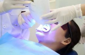 Tại sao tẩy trắng räng bị bỏng nướu?