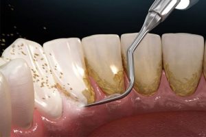 Người bị tiểu đường cạo vôi răng được không? Lưu ý quan trọng