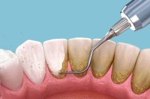 Thời gian nên kiêng hút thuốc và cách chăm sóc?