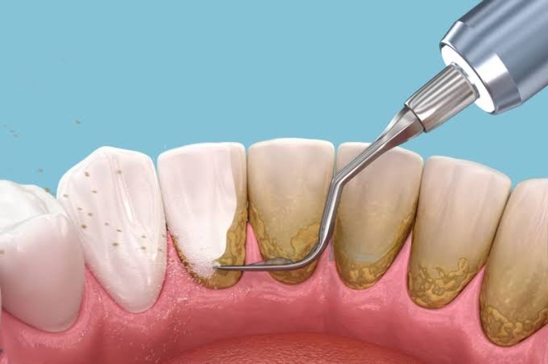 Cạo vôi có cần thuốc tê không?