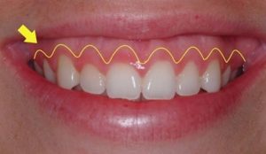 Cắt lợi có ảnh hưởng đến giọng nói không? Đáp án y tế
