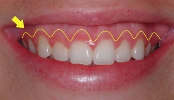 Cắt lợi có ảnh hưởng đến giọng nói không? Đáp án y tế