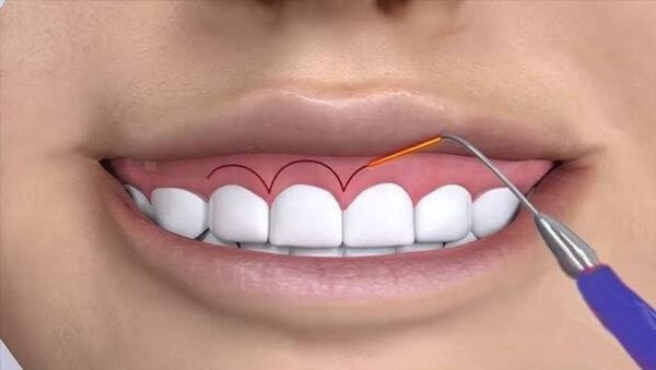 Phẫu thuật cắt lợi