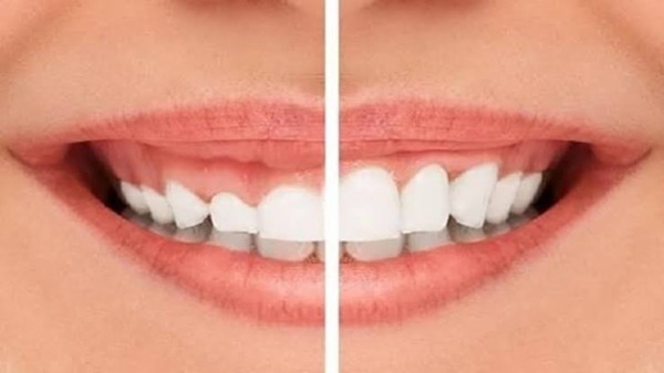 Cắt lợi được chỉ định khi nào? Quy trình và thời gian phục hồi?