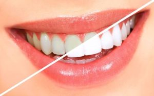 Tẩy trắng răng có an toàn không và cần chăm sóc ra sao sau khi tẩy?