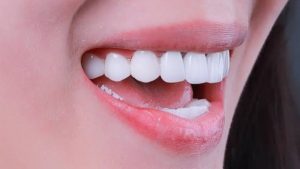 Tẩy trắng răng là gì và vì sao nhiều người lựa chọn?
