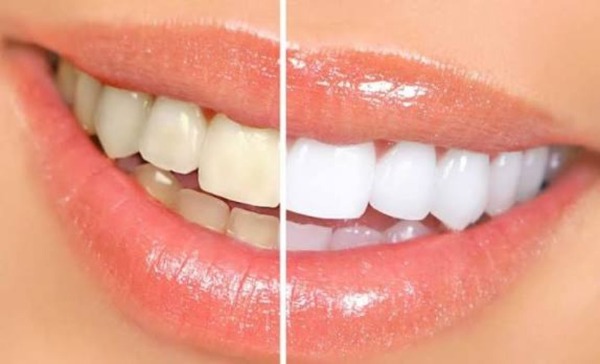 Tại sao tẩy trắng räng bị bỏng nướu?