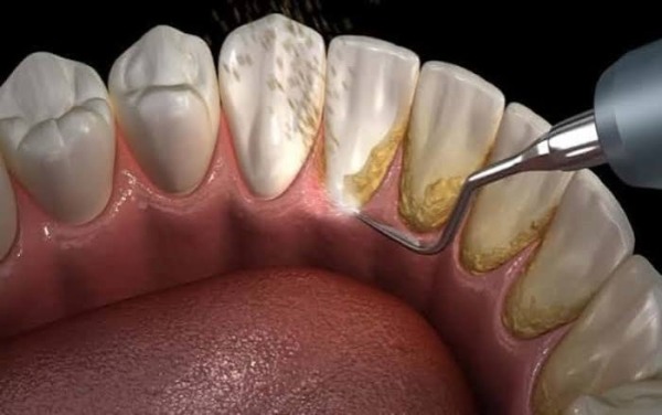 Tiểu đường ảnh hưởng đến sức khỏe răng miệng thế nào?