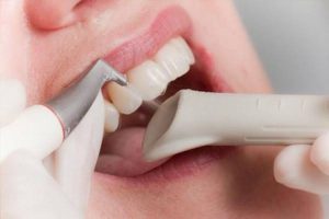 Cạo vôi bằng sóng siêu âm: An toàn, hiệu quả, không đau