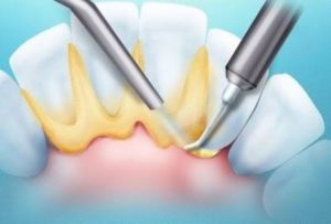 Cần chăm sóc thế nào sau cạo vôi?