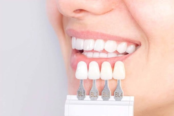 Veneer Lisi hoạt động như thế nào?