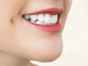Dán sứ veneer Lisi có tốt không? Hướng dẫn chi tiết