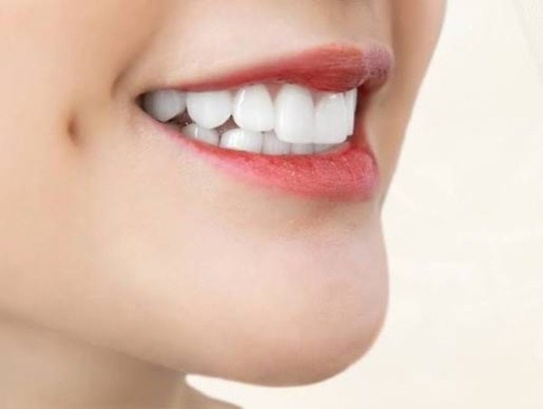 Dán sứ veneer Lisi có tốt không? Hướng dẫn chi tiết