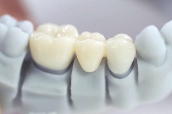 Thời điểm làm cầu răng sau khi nhổ răng cần được cân nhắc kỹ
