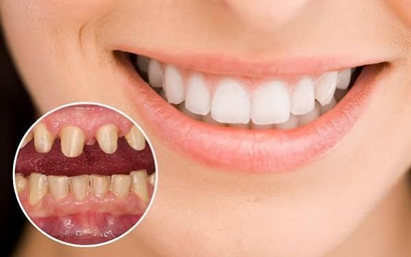Ai phù hợp dán veneer Lisi?