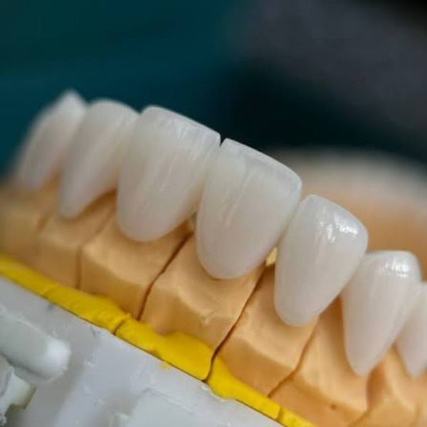 Dán sứ veneer có bị ê buốt không?