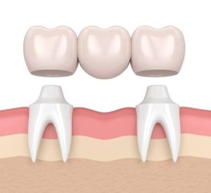 Nhổ răng bao lâu thì làm cầu răng được? Điều kiện và lưu ý cần biết